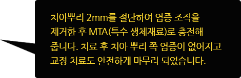 치아뿌리 2mm를 전달하여 염증 조직을 제거한 후 MTA(특수 생체재료)로 충전해 줍니다. 치료 후 치아 뿌리 쪽 염증이 없어지고 교정 치료도 안전하게 마무리 되었습니다.