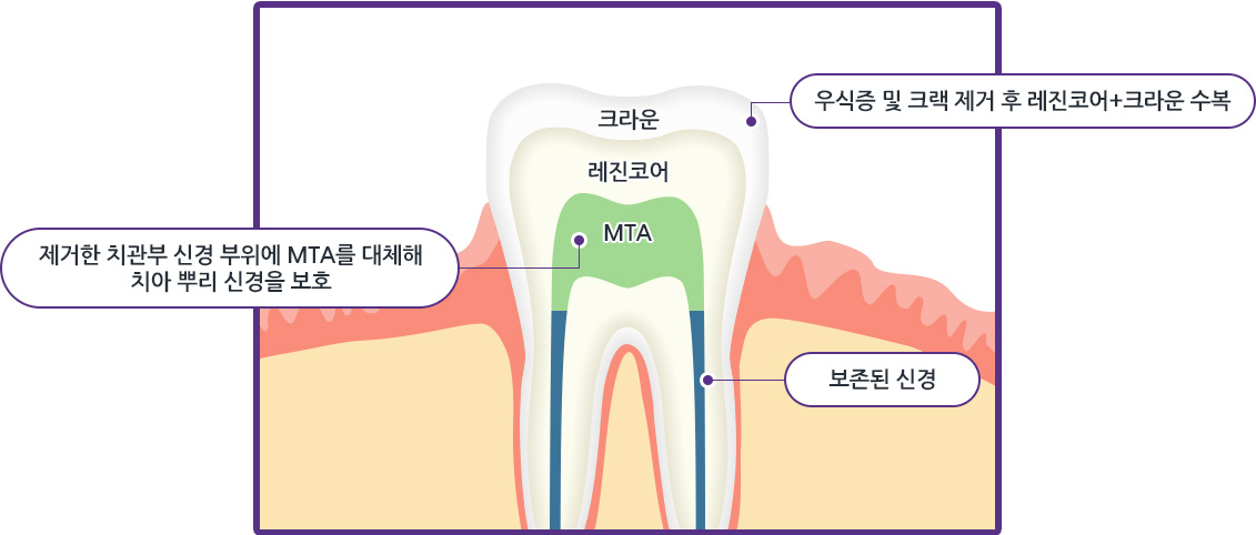 우식증 및 크랙 제거 후 레진코어+크라운 수복 / 제거한 치관부 신경 부위에 MTA를 대체해 치아 뿌리 신경을 보호 / 보존된 신경