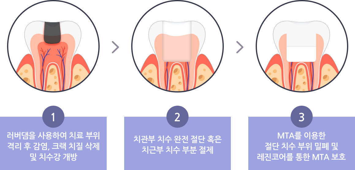 1.러버댐을 사용하여 치료 부위 격리 후 감염, 크랙 치질 삭제 및 치수강 개방 > 2.치관부 치수 완전 절단 혹은 치근부 치수 부분 절제 > 3.MTA를 이용한 절단 치수 부위 밀폐 및 레진코어를 통한 MTA 보호