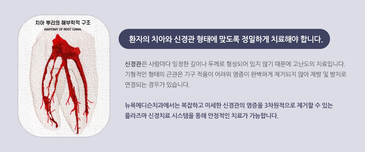 환자의 치아와 신경관 형태에 맞도록 정밀하게 치료해야 합니다. 신경관은 사람마다 일정한 길이나 두께로 형성되어 있지 않기 때문에 고난도의 치료입니다. 기형적인 형태의 근관은 기구 적용이 어려워 염증이 완벽하게 제거되지 않아 재발 및 발치로 연결되는 경우가 있습니다. 뉴욕메디슨치과에서는 복잡하고 미세한 신경관의 염증을 3차원적으로 제거할 수 있는 플라즈마 신경치료 시스템을 통해 안정적인 치료가 가능합니다.