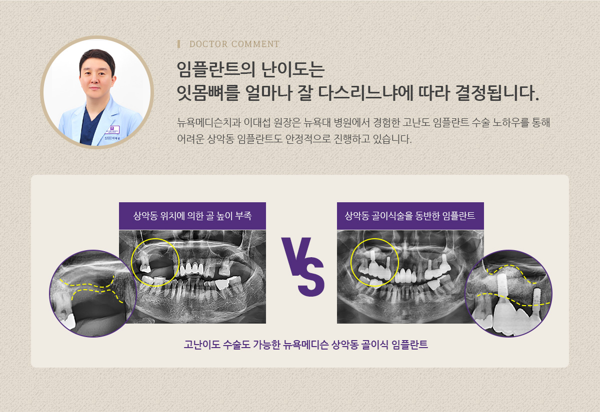 임플란트의 난이도는 잇몸뼈를 얼마나 잘 다스리느냐에 따라 결정됩니다. 뉴욕메디슨치과 이대섭 원장은 뉴욕대 병원에서 경험한 고난도 임플란트 수술 노하우를 통해 어려운 상악동 임플란트도 안정적으로 진행하고 있습니다.(고난이도 수술도 가능한 뉴욕메디슨 상악동 골이식 임플란트)