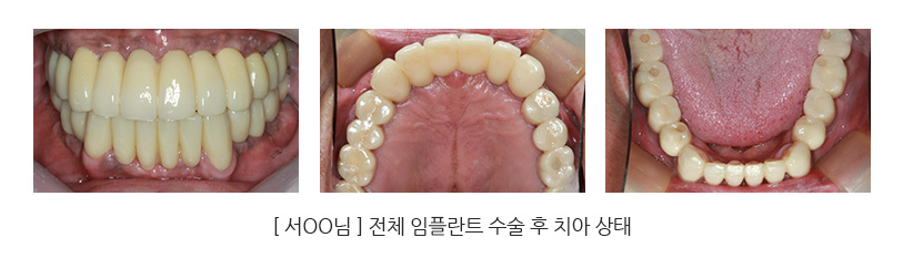 [ 서oo님 ] 전체 임플란트 수술 후 치아 상태