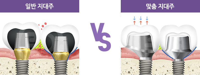 일반 지대주 VS 맞춤 지대주